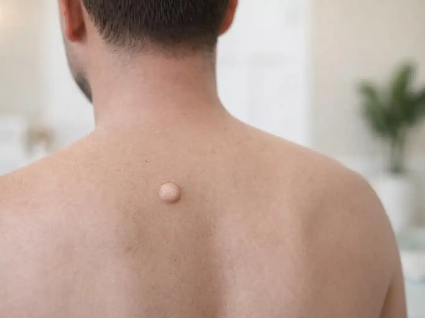 atheroma Atheroma vagy másnéven kásadaganat a háton.